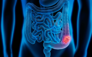 Cáncer colorrectal
